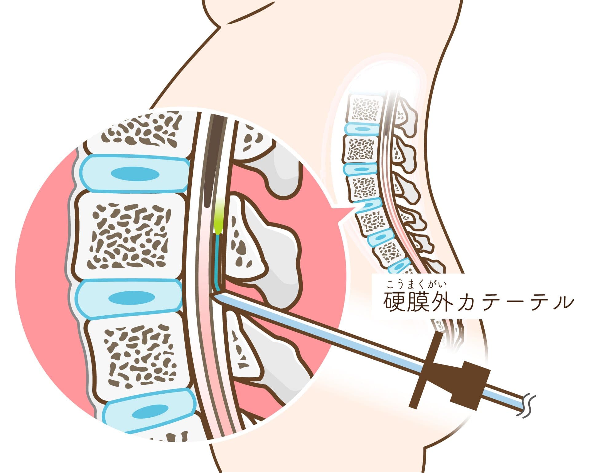 硬膜外麻酔の解説